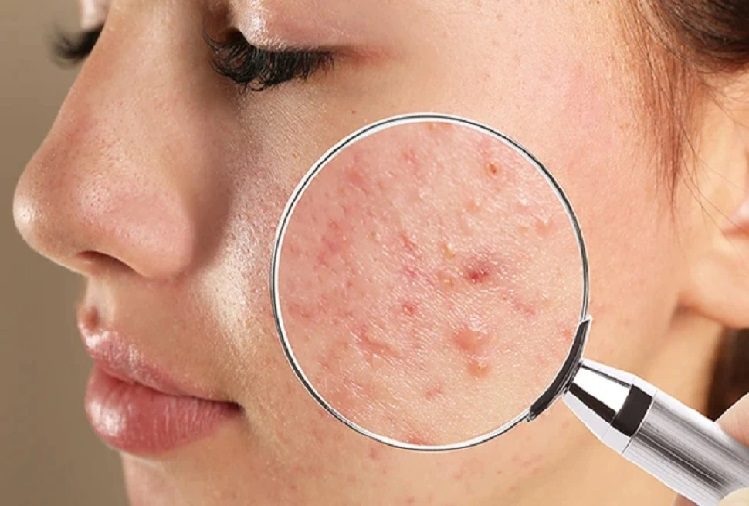 Beauty Tips: Pimples on your face will disappear quickly, just have to do this work