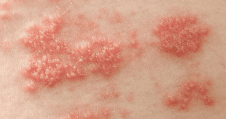 सेक्सुअली ट्रांसमिटेड