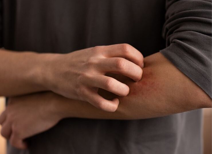 बारिश में हो गई है खुजली? इन तेलों से करें मालिश, मिलेगी राहत