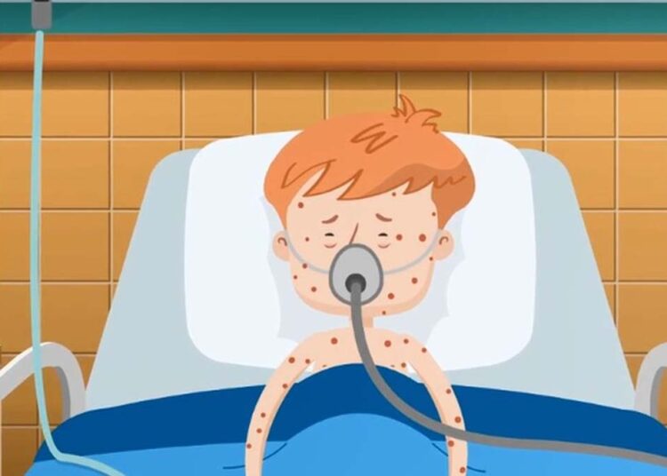 Vietnam में स्थास्थ्य मंत्रालय ने दी जानकारी,इस वर्ष खसरे के 42 मामले आए सामने