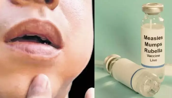 मम्प्स का प्रकोप