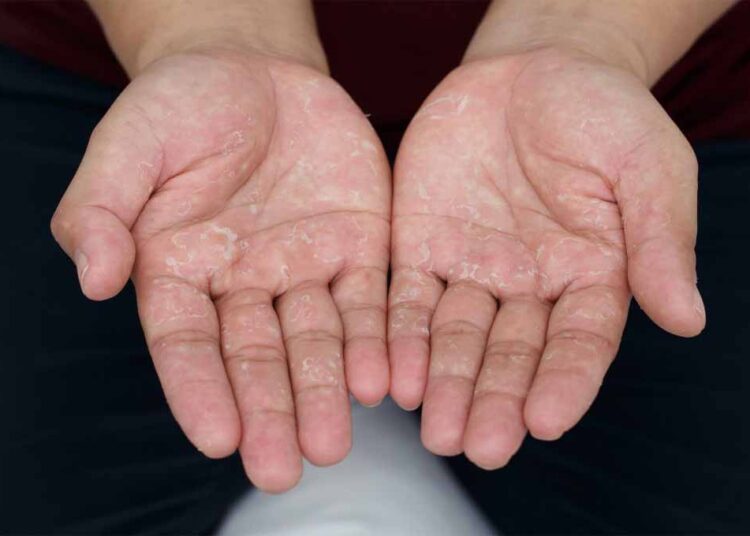 स्किन पीलिंग से है परेशान, तो फॉलो करें ये सरल स्टेप्स, मिलेगी कोमल व साफ़ त्वचा