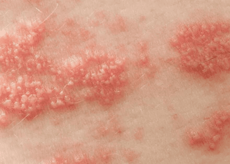 सेक्सुअली ट्रांसमिटेड