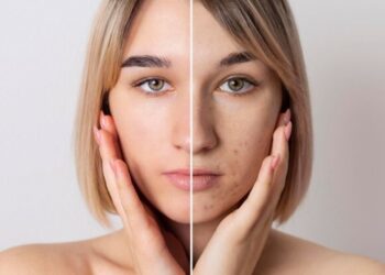 पिग्मेंटेशन ने चेहरे की खूबसूरती पर लगा दिया है धब्बा? एक्सपर्ट से जानिए सही इलाज