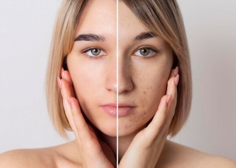 पिग्मेंटेशन ने चेहरे की खूबसूरती पर लगा दिया है धब्बा? एक्सपर्ट से जानिए सही इलाज