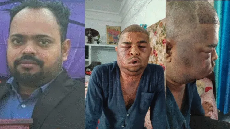 Hair Transplant से बिगड़ी ज़िंदगी! 2 इंजीनियरों की मौत, कई चेहरे भी हुए खराब 1 Hair Transplant two died