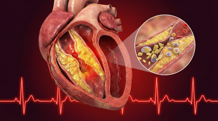 High Cholesterol से Heart Attack का खतरा: 81% भारतीय इस बीमारी से परेशान 1 Dyslipidemia