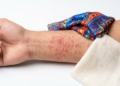Textile Dermatitis: कपड़े पहनते ही Skin में खुजली और दाने? जान लीजिए वजह और बचाव 3 Textile Dermatitis