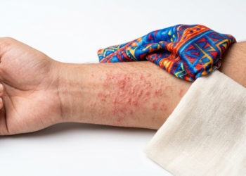 Textile Dermatitis