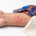Textile Dermatitis
